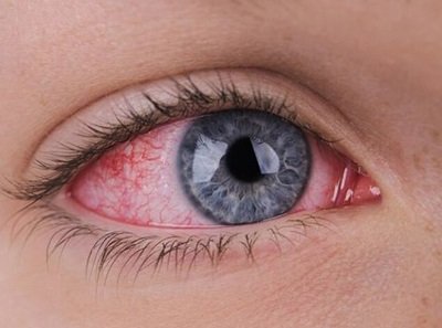 Dry-Eye-Disease