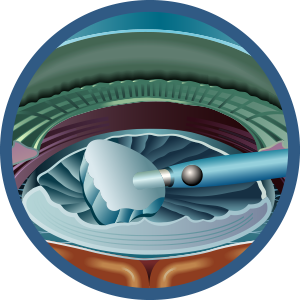 Cataract-Surgery-Steps