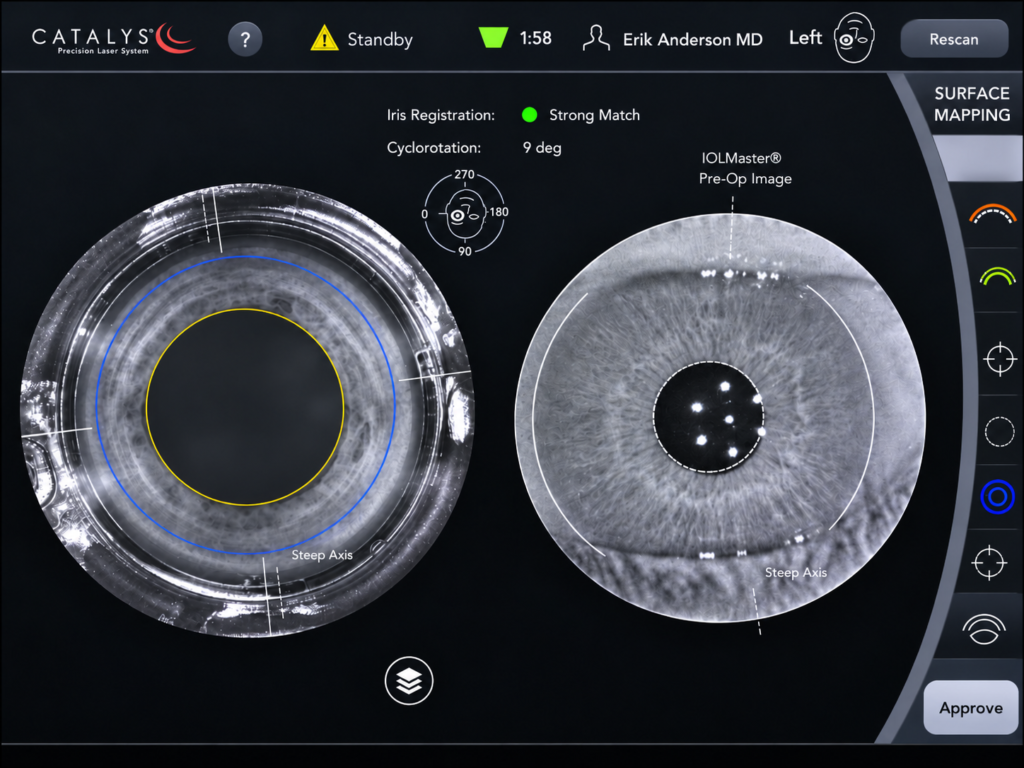 Catalys laser cataract surgery iris registration matched to the pre-operative image to correct cyclotorsion