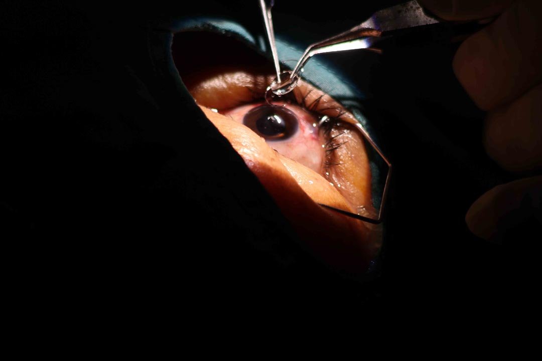 cataract-surgery-honduras-iol