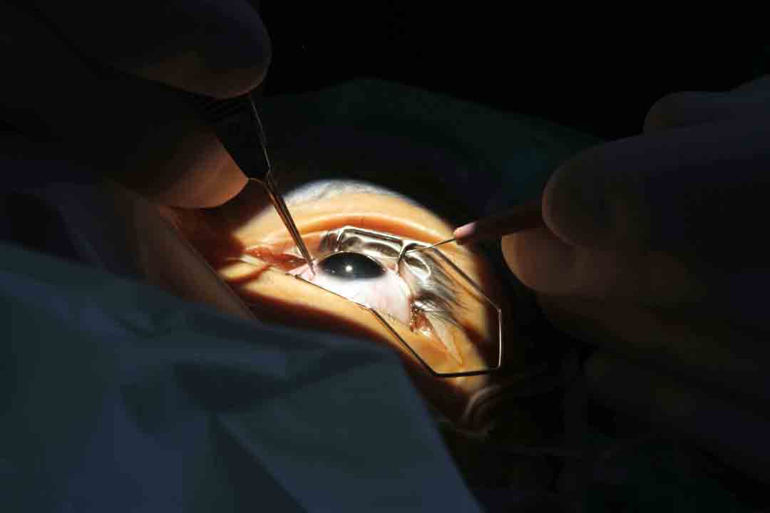 cataract-surgery-honduras