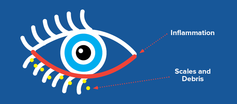 Blepharitis-Eye-Condition